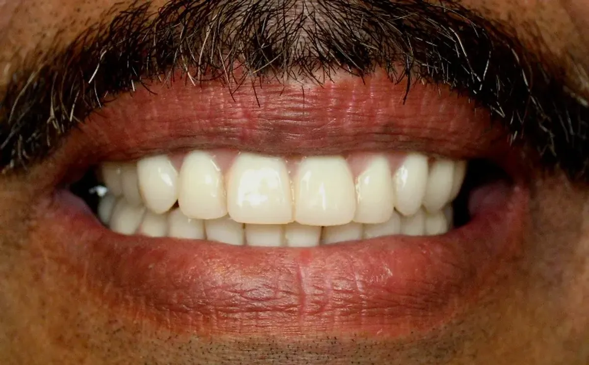 Case 1 — after treatment at Capital Dental Group