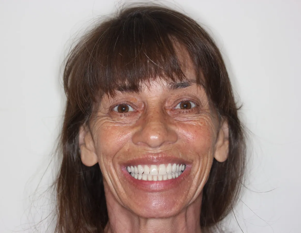 Case 2 — after treatment at Capital Dental Group