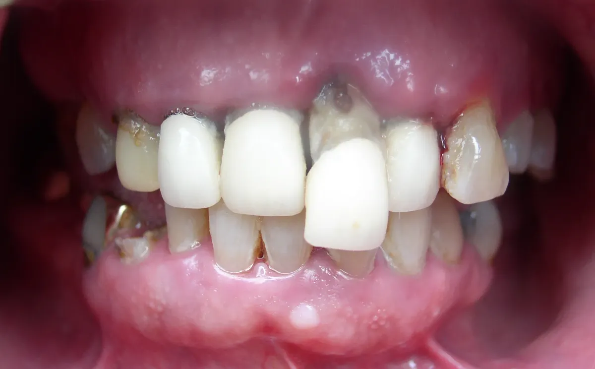 Case 5 — before treatment at Capital Dental Group