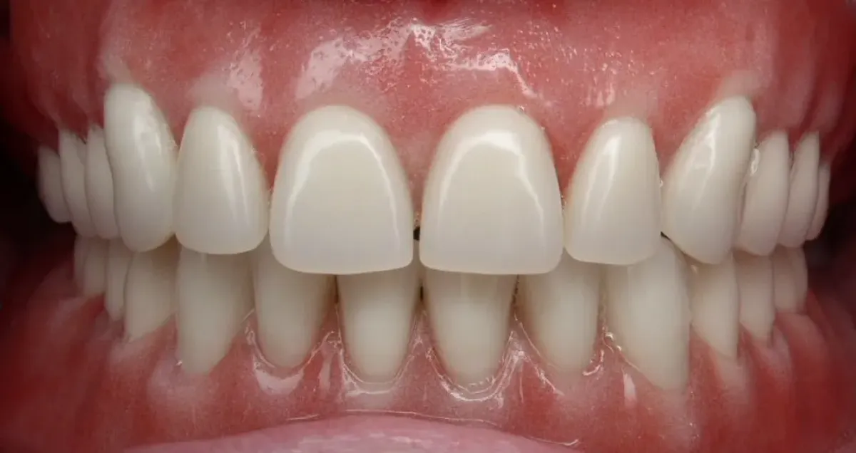 Case 7 — after treatment at Capital Dental Group