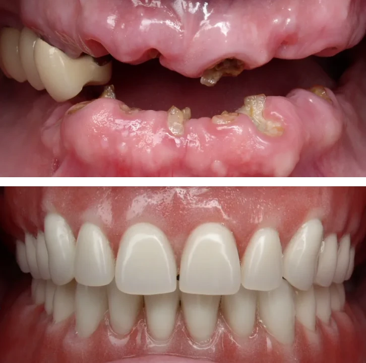 Before and after full-arch implant transformation at Center for Implant Dentistry