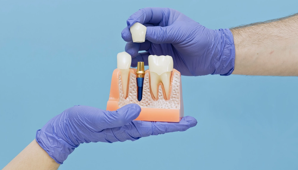 Dental Implant Model